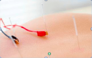 Electro-acupuncture improves blood flow
