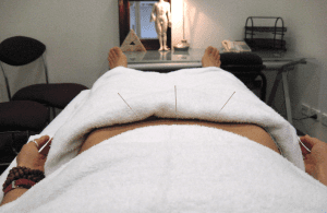 Acupuncture before embryo transfer