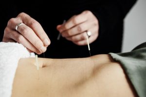 acupuncture in the belly