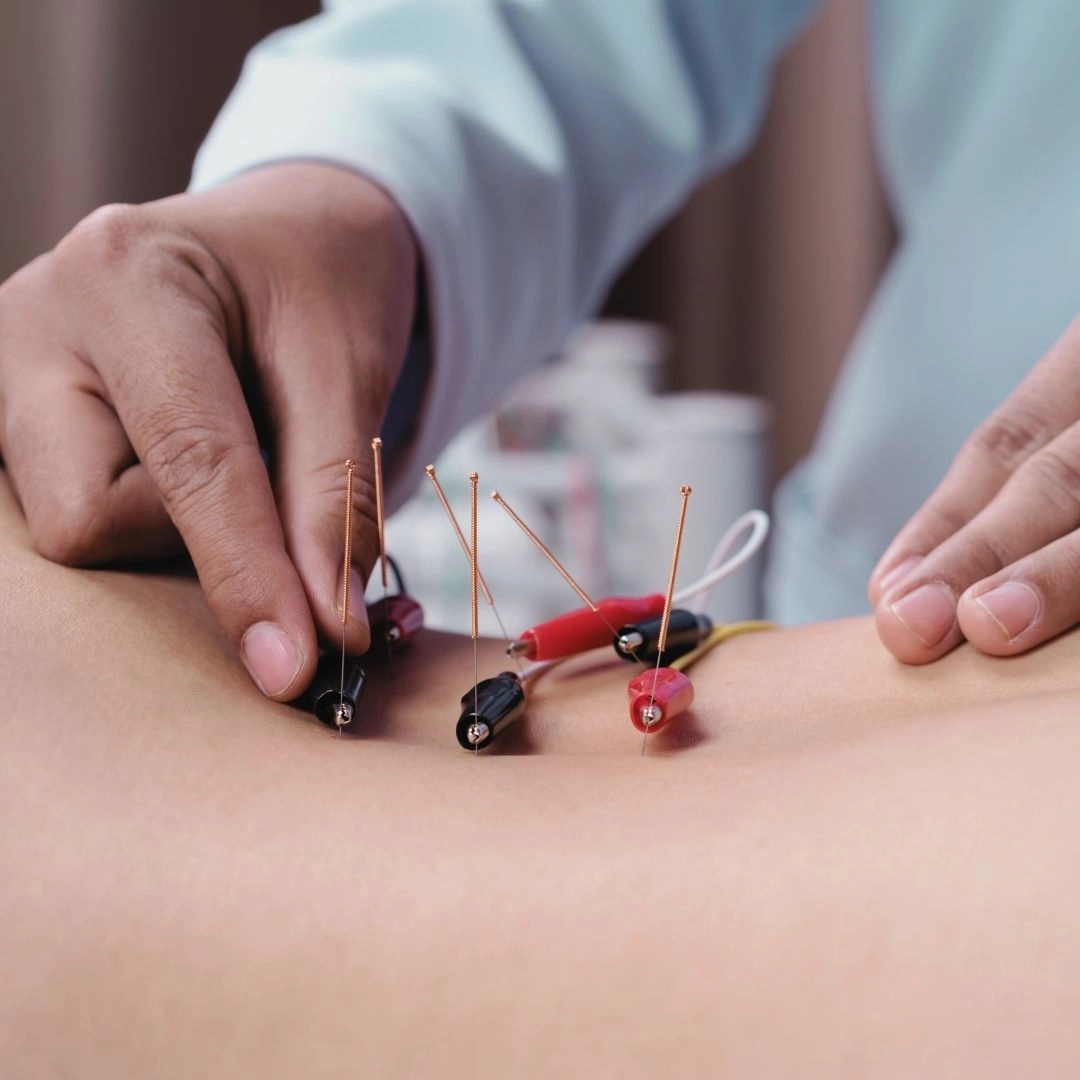 An image of hands performing electroacupuncture