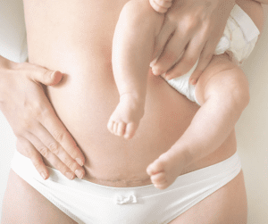 supporting caesarean recovery