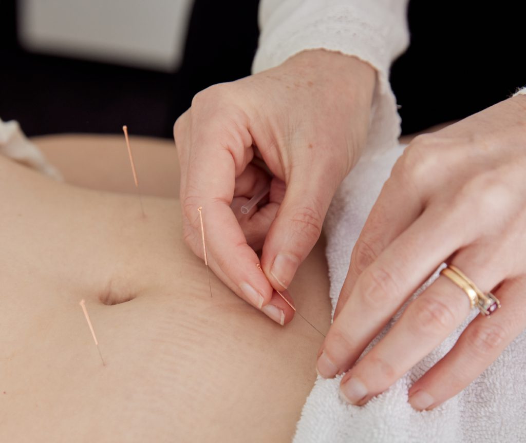 performing acupuncture