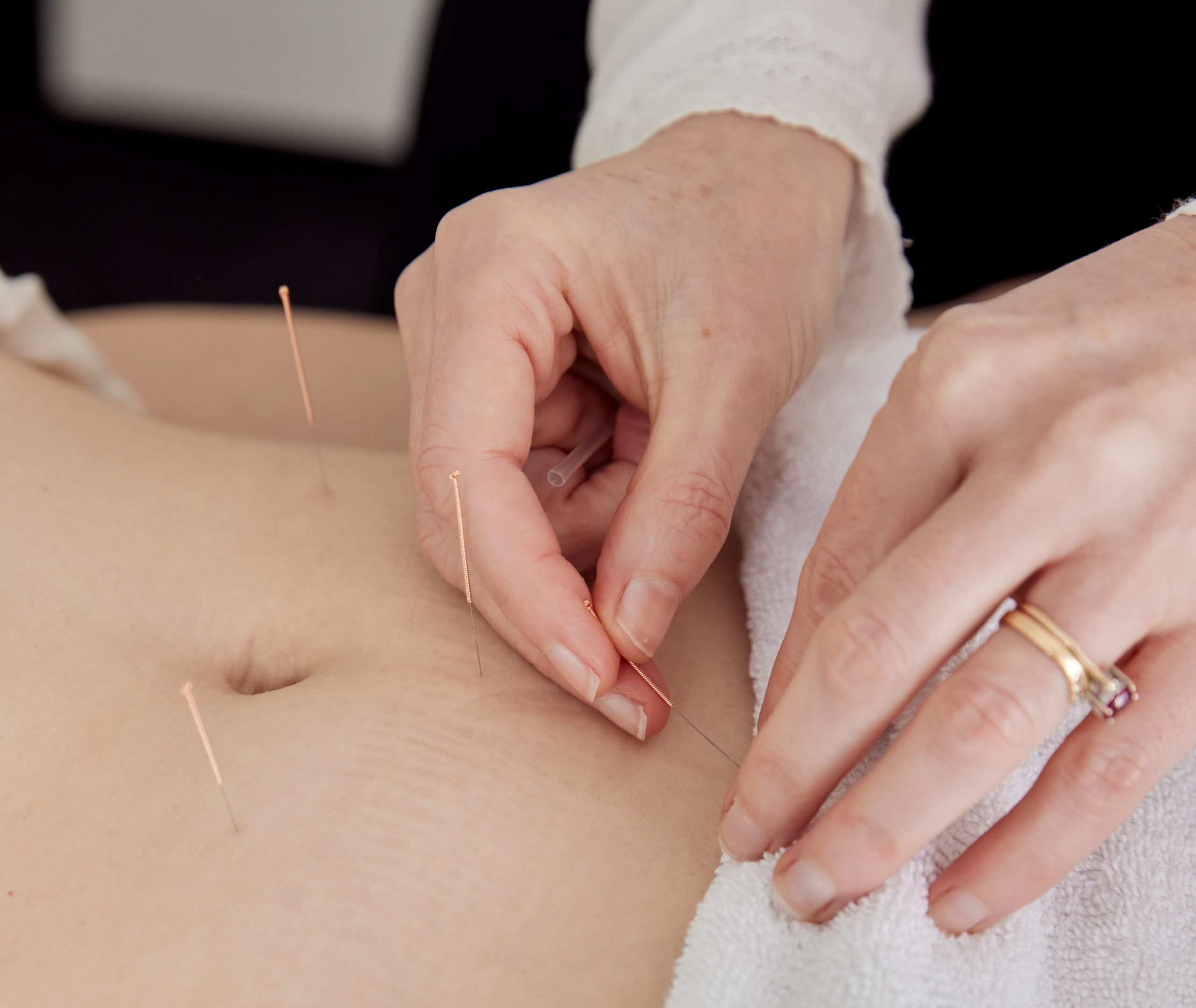 performing acupuncture in lower abdomen
