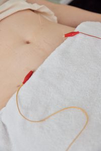 Electroacupuncture - Acupuncture Pregnancy Clinic Women receiving electroacupuncture treatment in lower abdomen