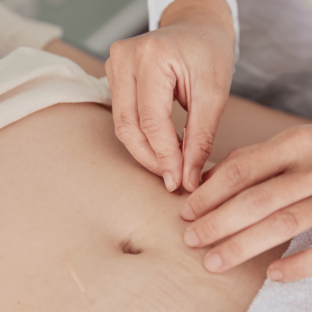 Acupuncture for Endometriosis