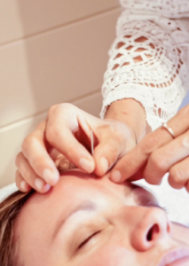 A woman receiving acupuncture treatment at Mornington Clinic A woman receiving acupuncture treatment at Mornington Clinic