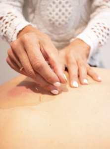 Acupuncture done by Cath Brown Acupuncture done by Cath Brown