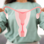 PCOS
